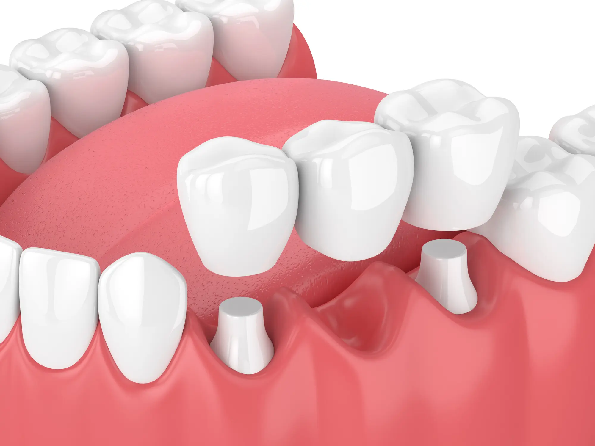 Dental Implant Treatment