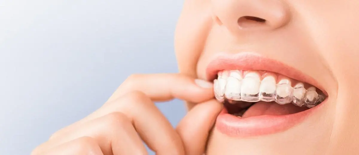 Invisalign Tedavisinde Ataşman Uygulaması