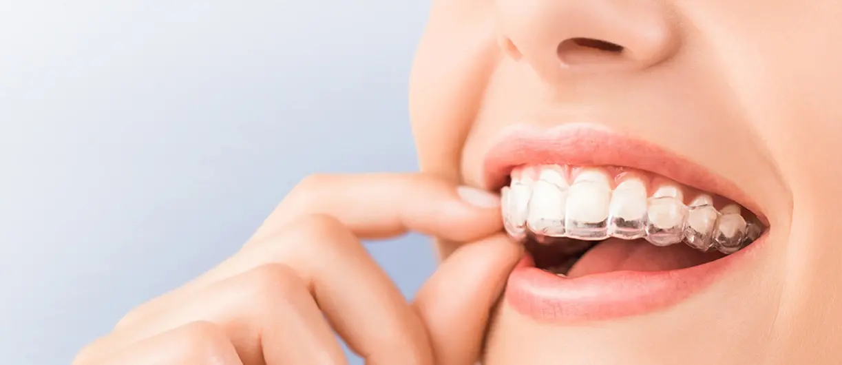 Invisalign Tedavisinde Ataşman Uygulaması Nedir?