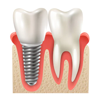 Dental İmplant Sonrası