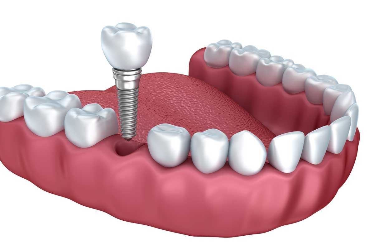 Dental İmplant Teknolojileri