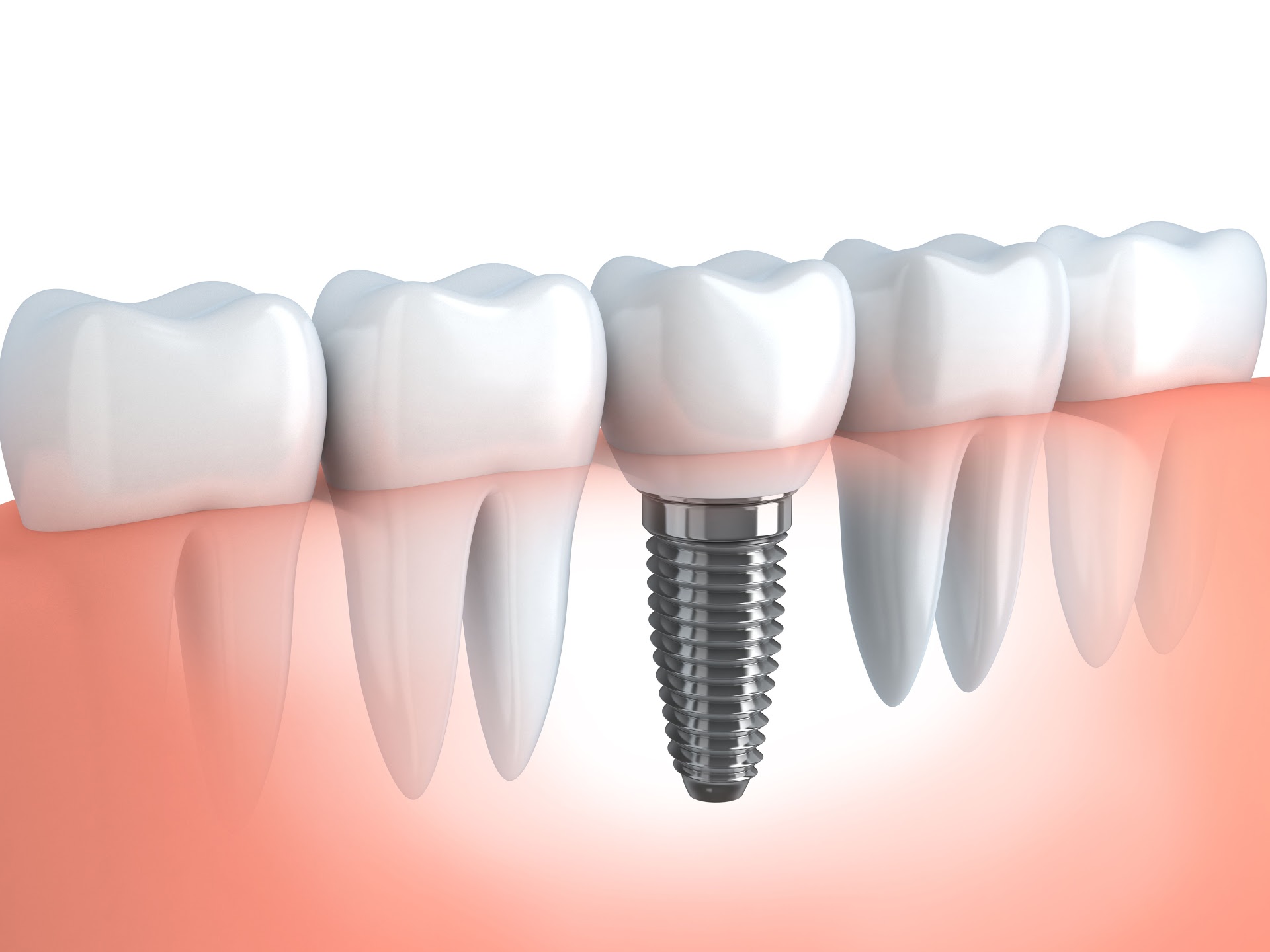 Dental İmplant Teknolojileri 