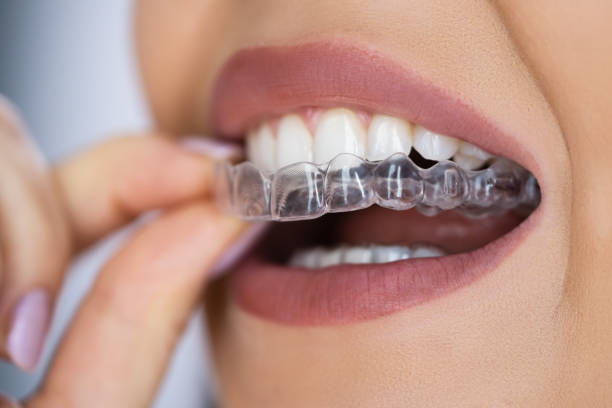 Invisalign Tedavisi Nedir?