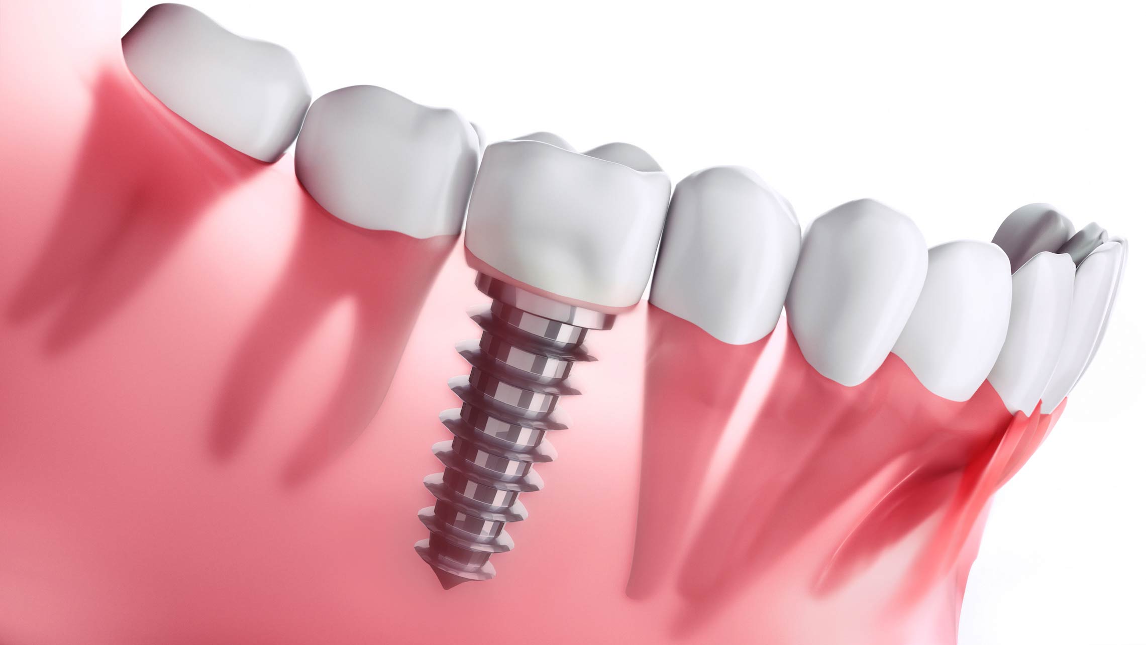 Dental İmplant Tedavisi Nedir?