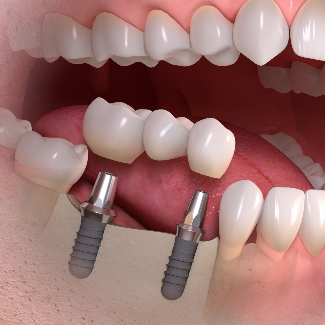 Dental İmplant Tedavisi Nedir?