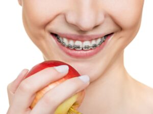 Ortodonti Tedavisi Nedir?