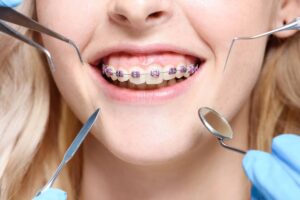 Ortodonti Tedavisi Nedir?