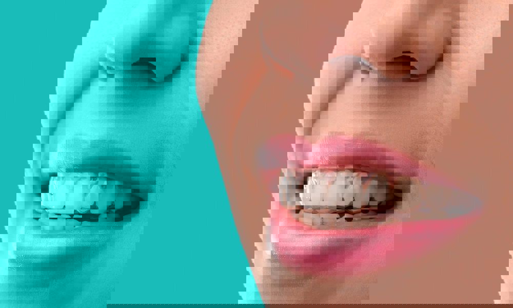 İnvisalign Tedavisi Fiyati