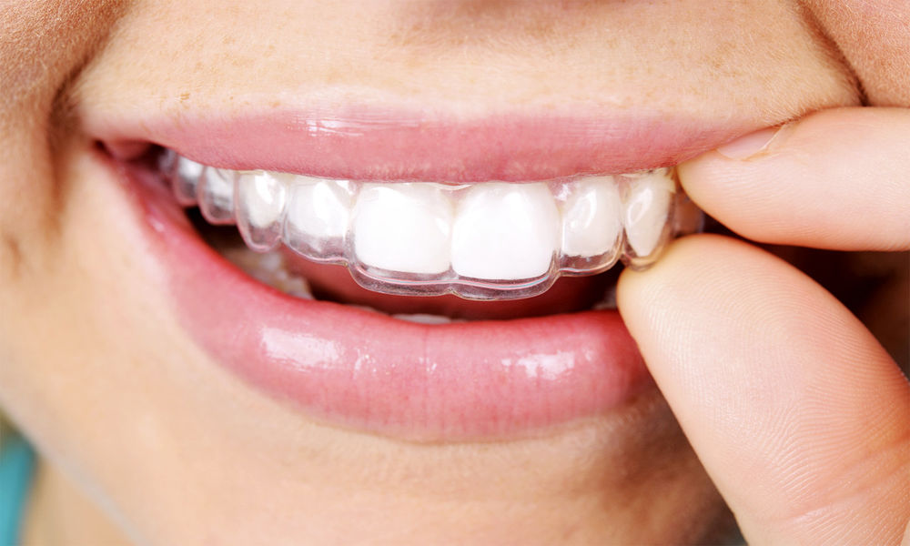 İnvisalign Tedavisi Ne Kadar Sürer
