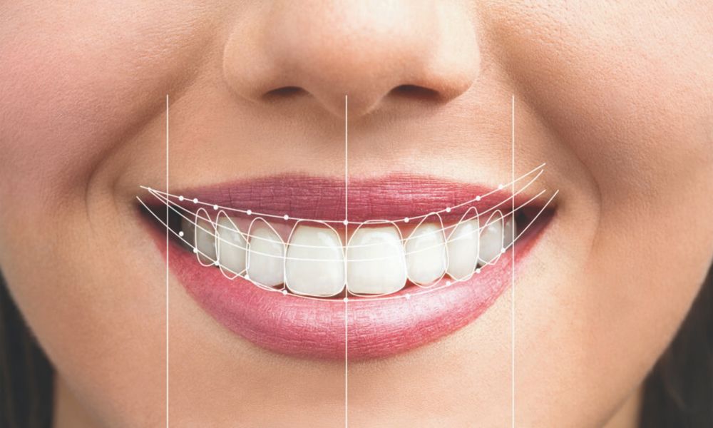 Gülüş Tasarımı Nedir?