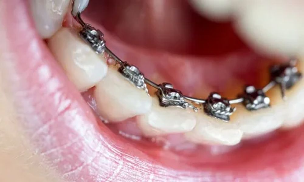 Lingual Ortodonti Nedir