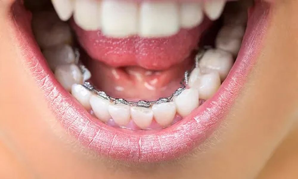 Lingual Ortodonti Nedir